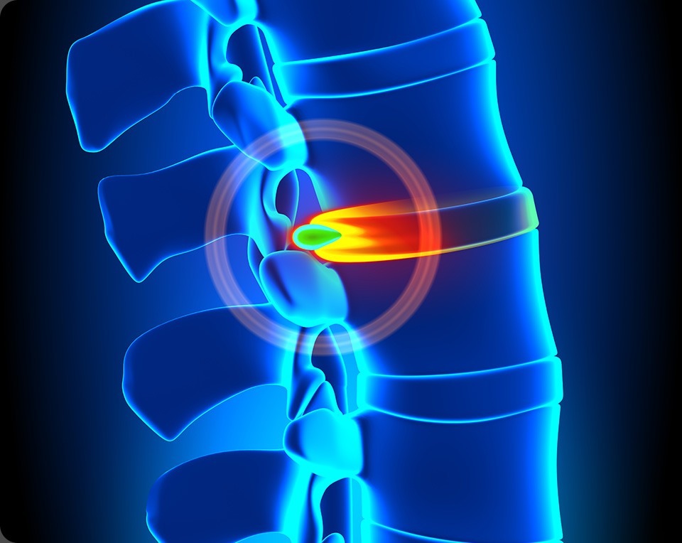 Herniated Disc | Max Physiotherapy | Physiotherapy, Chiropractic, Massage and Health & Wellness Clinic | NE Calgary